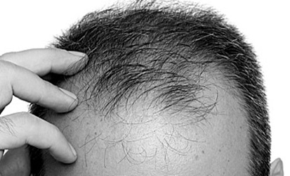  Tıraşsız Saç Ekimi ve Tıraşlı Saç Ekimi Unshaven Hair Transplantation and Shaved Hair Transplantation-de