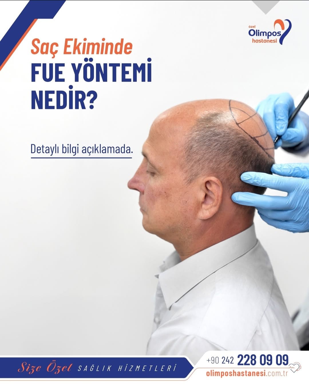 FUE YÖNTEMİ İLE SAÇ EKİMİ